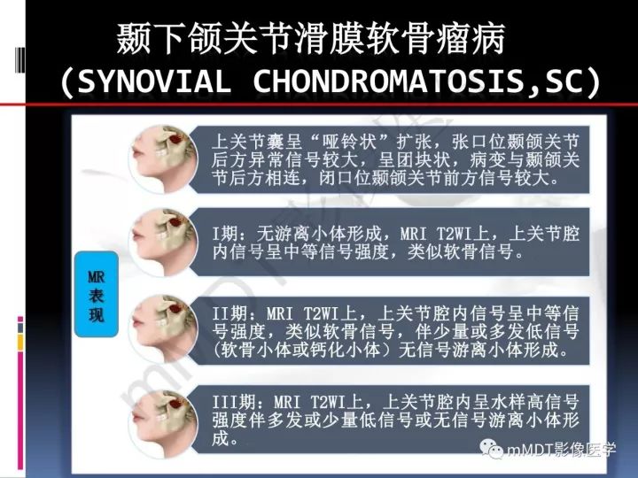 【PPT】颞下颌关节滑膜骨软骨瘤病MR分期诊断