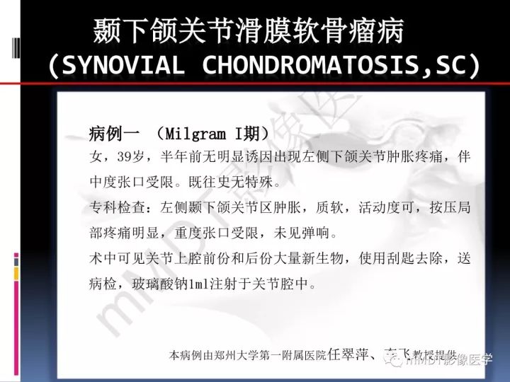 【PPT】颞下颌关节滑膜骨软骨瘤病MR分期诊断
