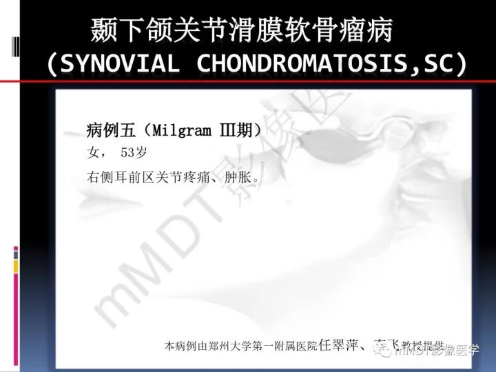 【PPT】颞下颌关节滑膜骨软骨瘤病MR分期诊断
