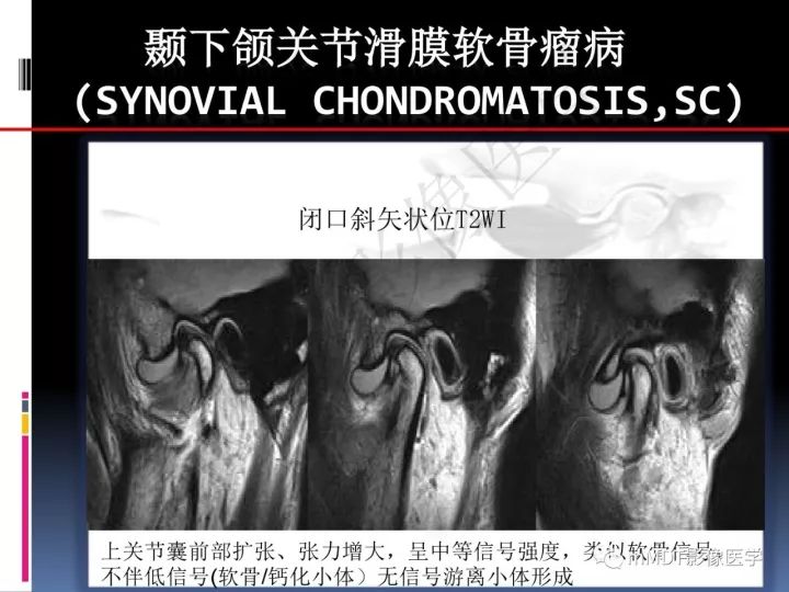 【PPT】颞下颌关节滑膜骨软骨瘤病MR分期诊断