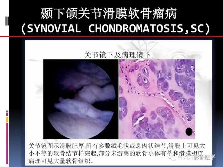 【PPT】颞下颌关节滑膜骨软骨瘤病MR分期诊断
