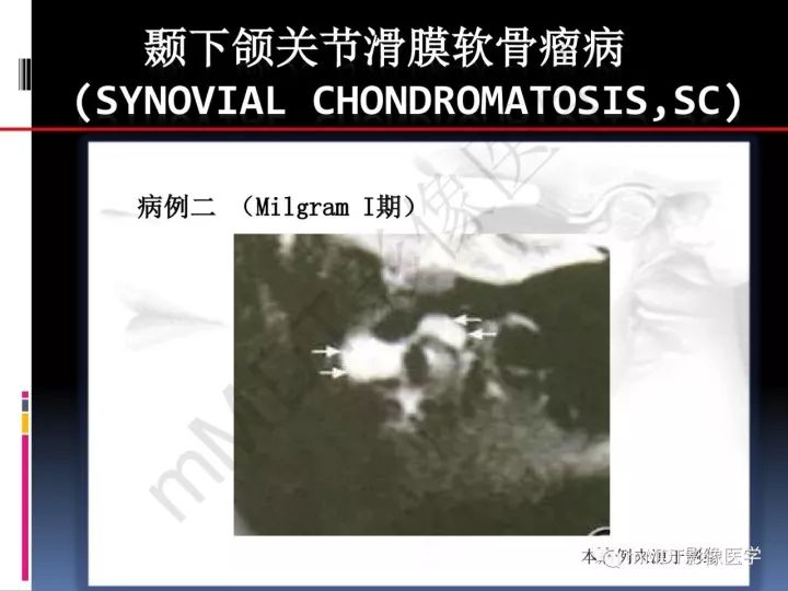 【PPT】颞下颌关节滑膜骨软骨瘤病MR分期诊断