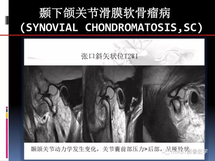 【PPT】颞下颌关节滑膜骨软骨瘤病MR分期诊断