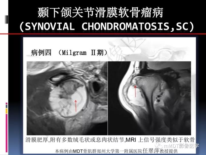 【PPT】颞下颌关节滑膜骨软骨瘤病MR分期诊断