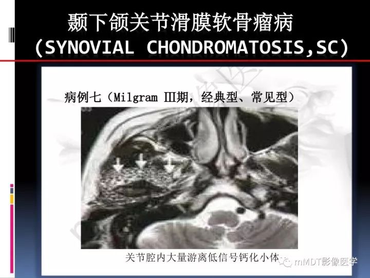 【PPT】颞下颌关节滑膜骨软骨瘤病MR分期诊断