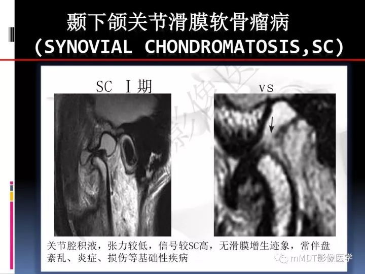 【PPT】颞下颌关节滑膜骨软骨瘤病MR分期诊断