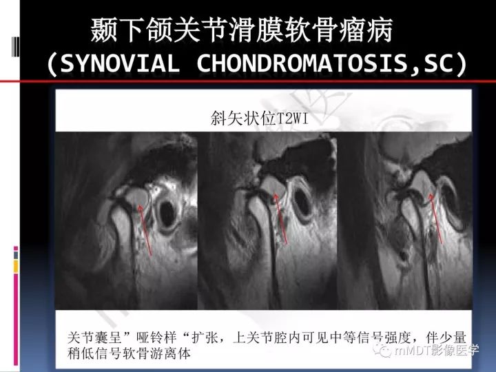 【PPT】颞下颌关节滑膜骨软骨瘤病MR分期诊断
