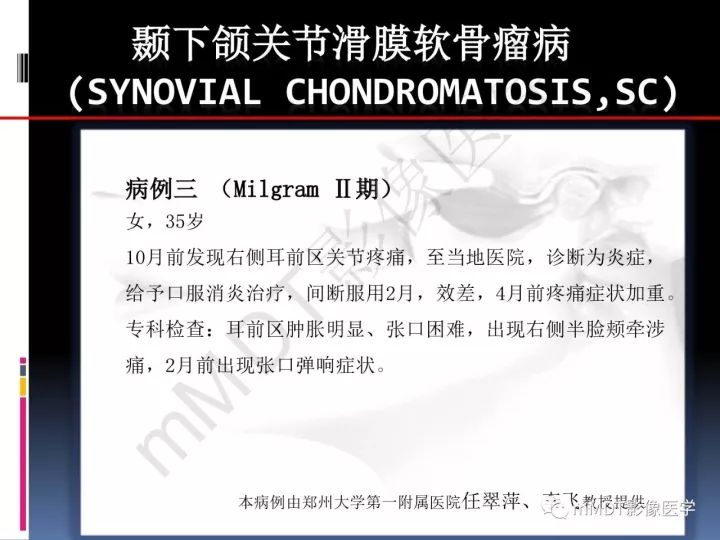 【PPT】颞下颌关节滑膜骨软骨瘤病MR分期诊断
