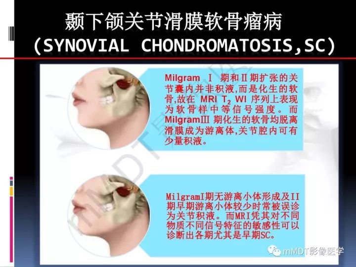 【PPT】颞下颌关节滑膜骨软骨瘤病MR分期诊断