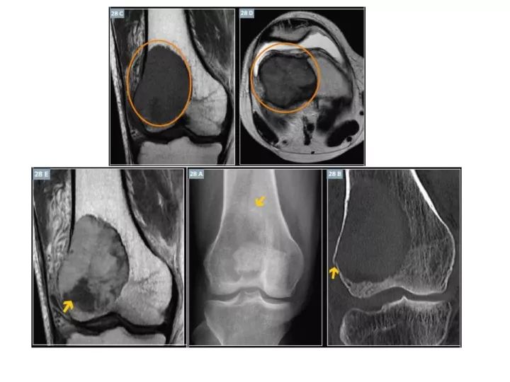 【PPT】良恶性骨肿瘤的影像诊断和图像特征