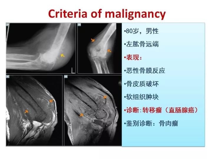 【PPT】良恶性骨肿瘤的影像诊断和图像特征