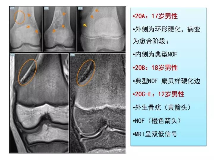 【PPT】良恶性骨肿瘤的影像诊断和图像特征