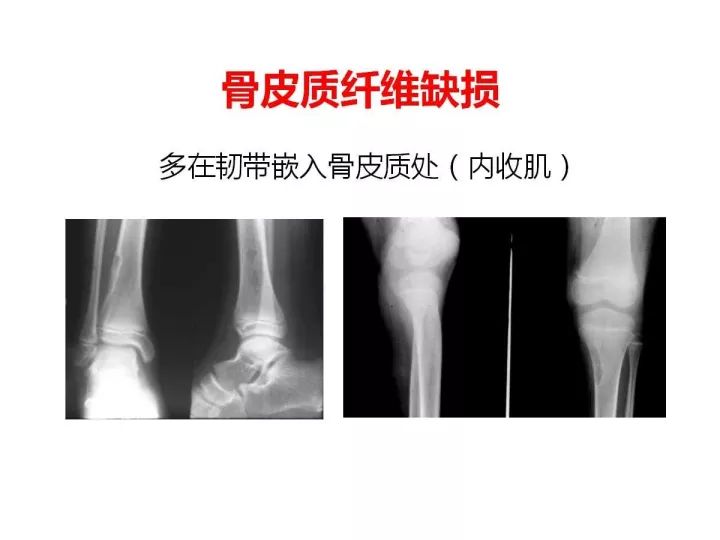 【PPT】良恶性骨肿瘤的影像诊断和图像特征