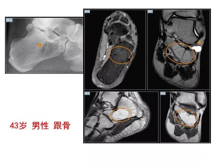 【PPT】良恶性骨肿瘤的影像诊断和图像特征
