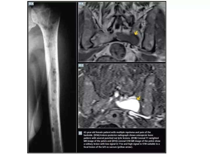【PPT】良恶性骨肿瘤的影像诊断和图像特征