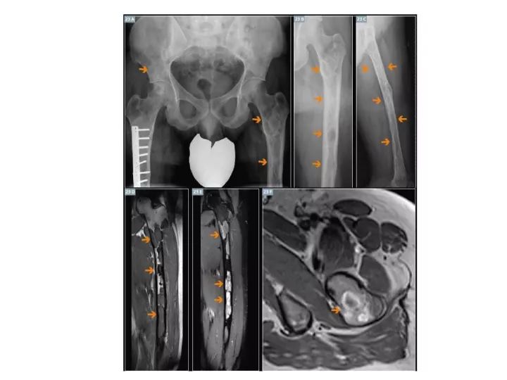 【PPT】良恶性骨肿瘤的影像诊断和图像特征