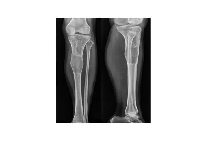 【PPT】良恶性骨肿瘤的影像诊断和图像特征