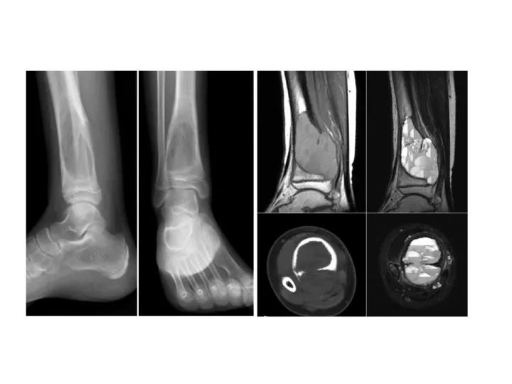 【PPT】良恶性骨肿瘤的影像诊断和图像特征