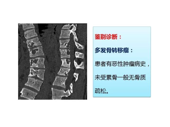 【PPT】良恶性骨肿瘤的影像诊断和图像特征