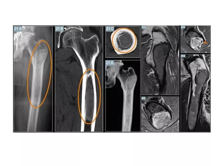 【PPT】良恶性骨肿瘤的影像诊断和图像特征