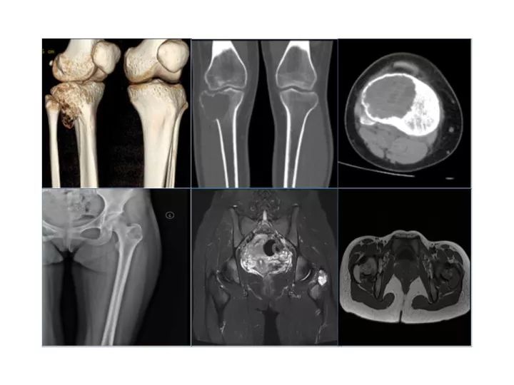 【PPT】良恶性骨肿瘤的影像诊断和图像特征