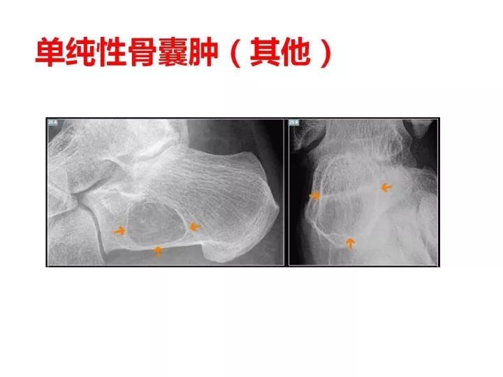 【PPT】良恶性骨肿瘤的影像诊断和图像特征
