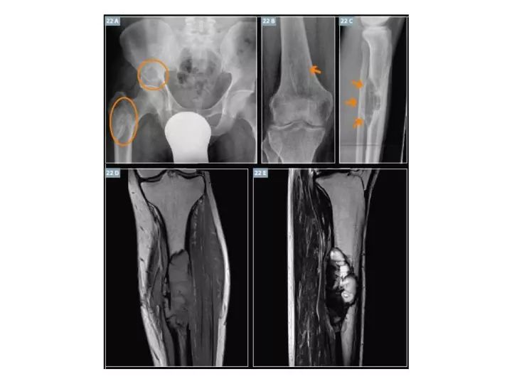 【PPT】良恶性骨肿瘤的影像诊断和图像特征