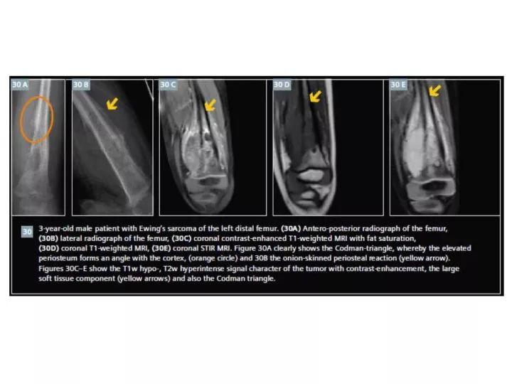 【PPT】良恶性骨肿瘤的影像诊断和图像特征