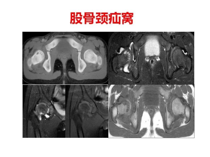 【PPT】良恶性骨肿瘤的影像诊断和图像特征
