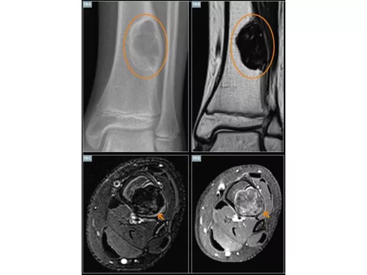 【PPT】良恶性骨肿瘤的影像诊断和图像特征