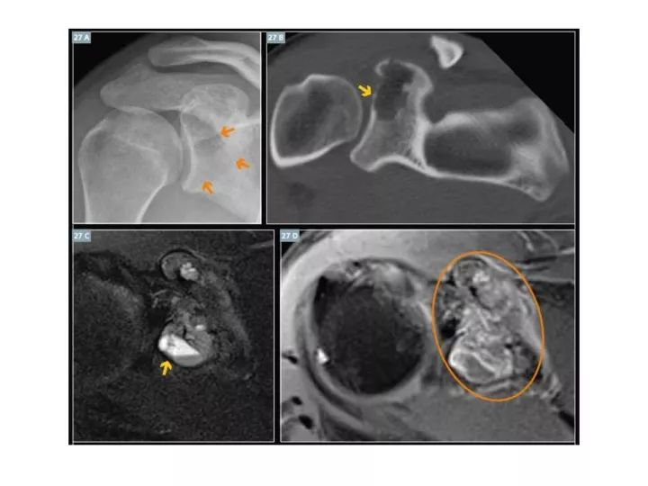 【PPT】良恶性骨肿瘤的影像诊断和图像特征