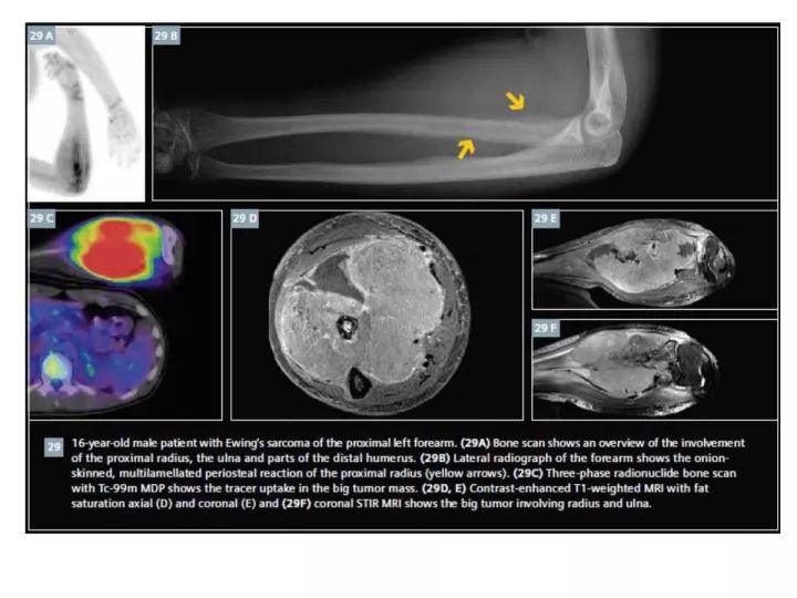 【PPT】良恶性骨肿瘤的影像诊断和图像特征