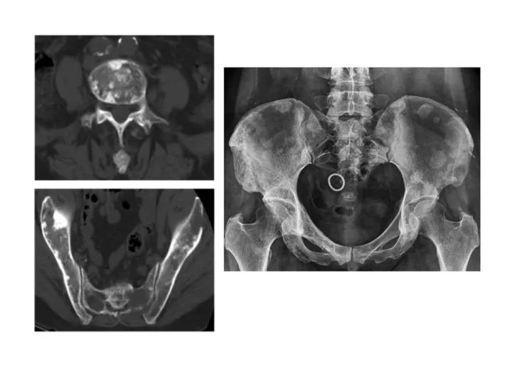 【PPT】良恶性骨肿瘤的影像诊断和图像特征