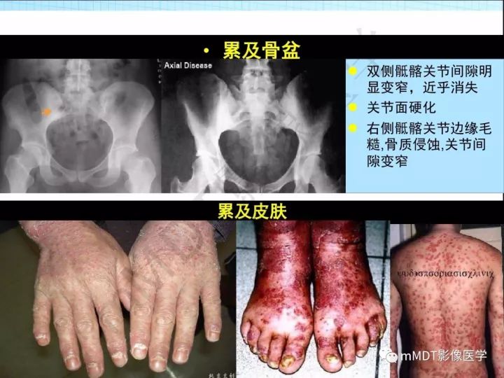【PPT】骶髂关节非肿瘤病变的影像诊断