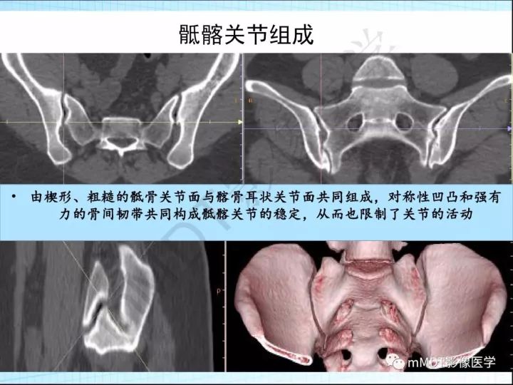 【PPT】骶髂关节非肿瘤病变的影像诊断
