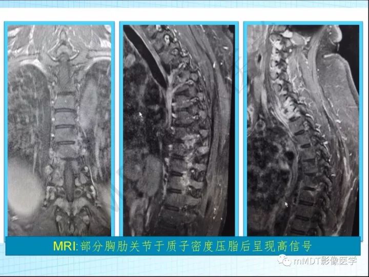 【PPT】骶髂关节非肿瘤病变的影像诊断