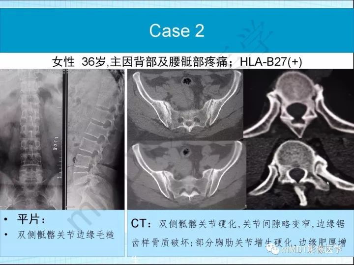 【PPT】骶髂关节非肿瘤病变的影像诊断