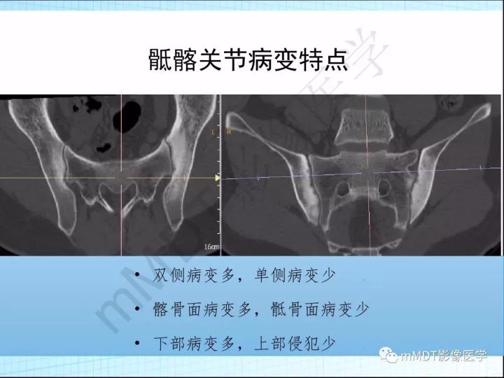 【PPT】骶髂关节非肿瘤病变的影像诊断