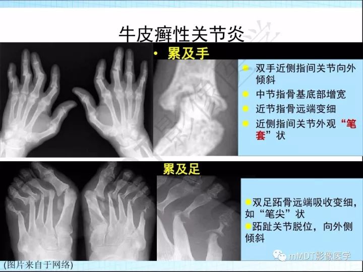 【PPT】骶髂关节非肿瘤病变的影像诊断