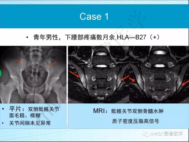【PPT】骶髂关节非肿瘤病变的影像诊断