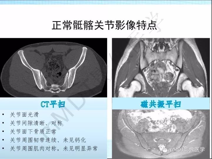 【PPT】骶髂关节非肿瘤病变的影像诊断