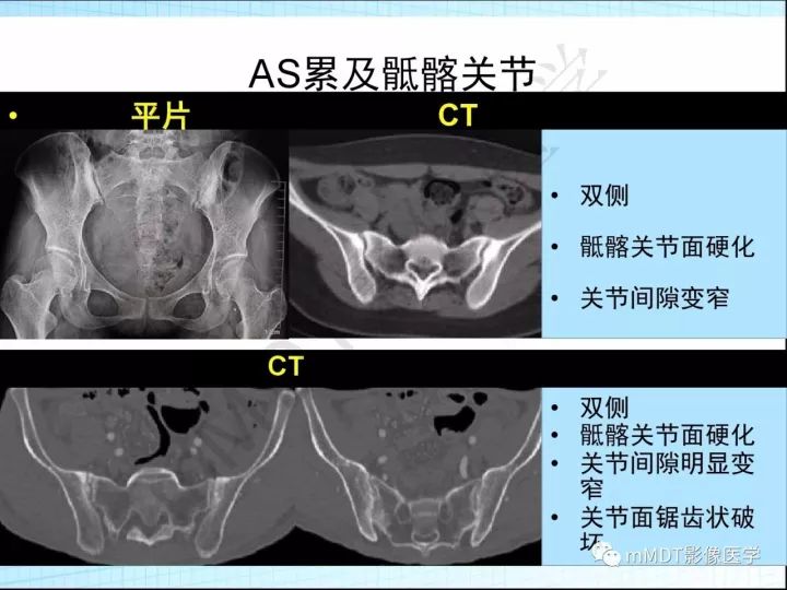 【PPT】骶髂关节非肿瘤病变的影像诊断