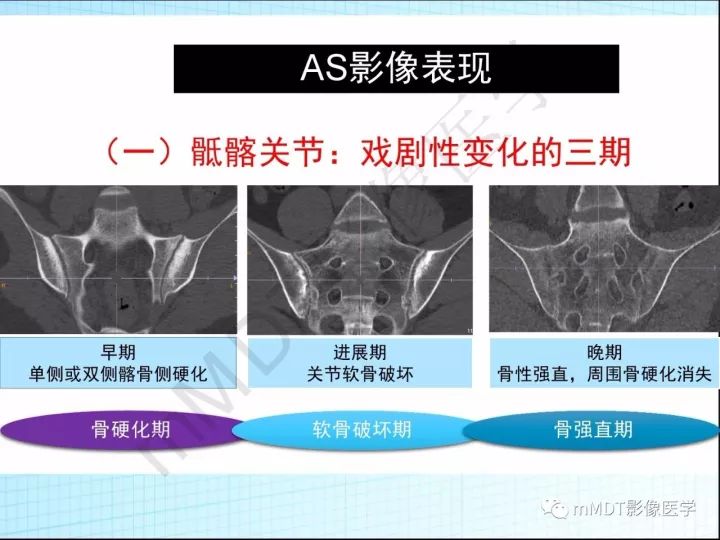 【PPT】骶髂关节非肿瘤病变的影像诊断