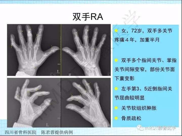 【PPT】骶髂关节非肿瘤病变的影像诊断