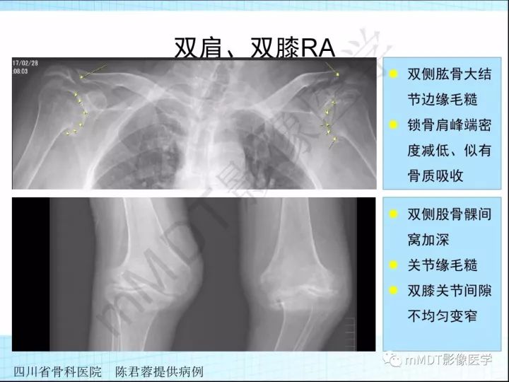 【PPT】骶髂关节非肿瘤病变的影像诊断