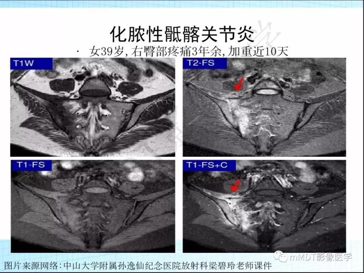 【PPT】骶髂关节非肿瘤病变的影像诊断