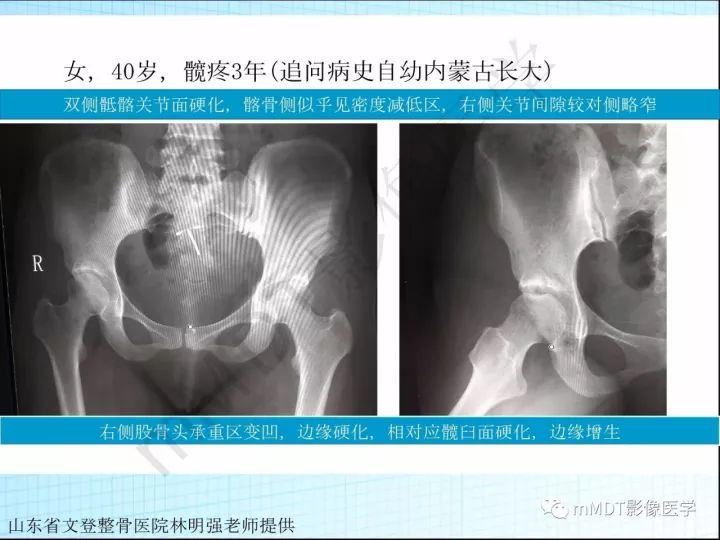 【PPT】骶髂关节非肿瘤病变的影像诊断
