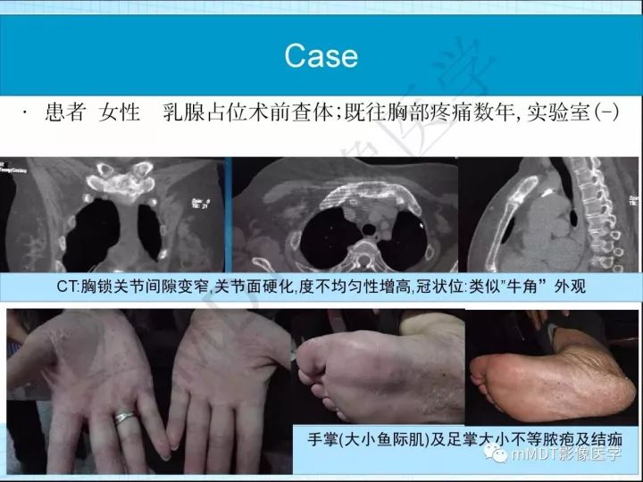 【PPT】骶髂关节非肿瘤病变的影像诊断