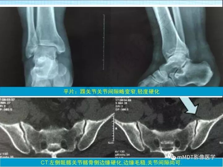 【PPT】骶髂关节非肿瘤病变的影像诊断
