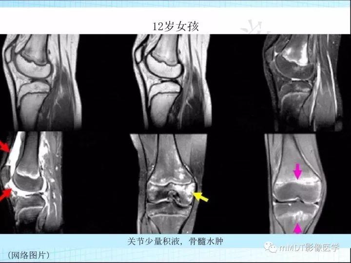 【PPT】骶髂关节非肿瘤病变的影像诊断